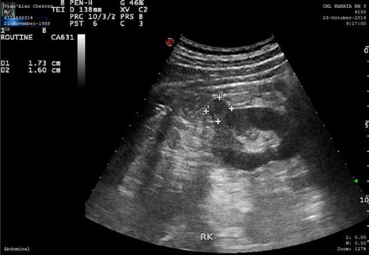 Ultrasound Right Kidney