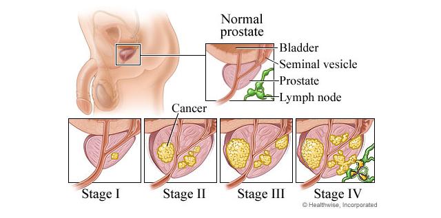 prostatecancer2